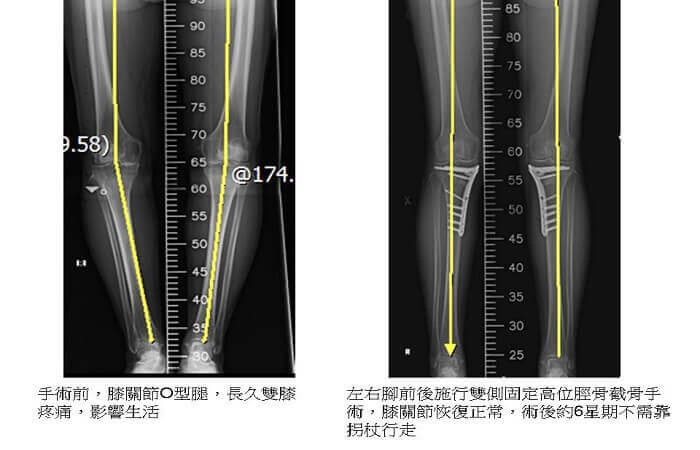 雙側固定高位脛骨截骨手術早日行走有 膝 望 台南市市立醫院 保膝手術 特急先鋒新聞網